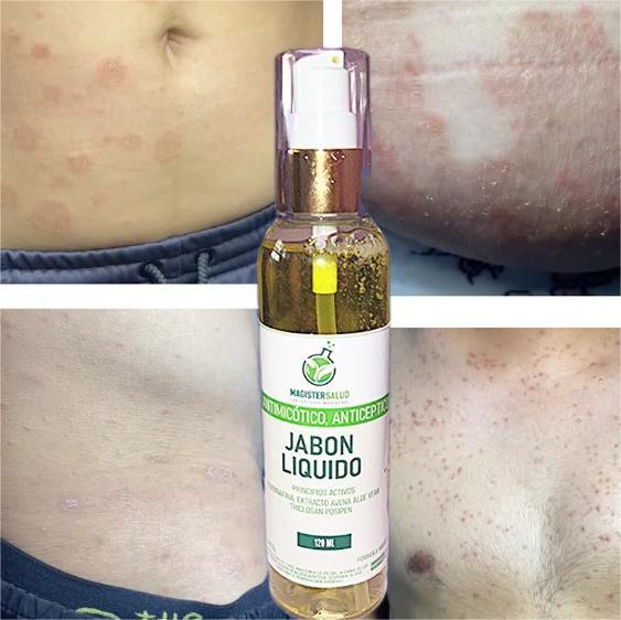 Jabón Líquido Antimicótico - Combate hongos en el cuerpo